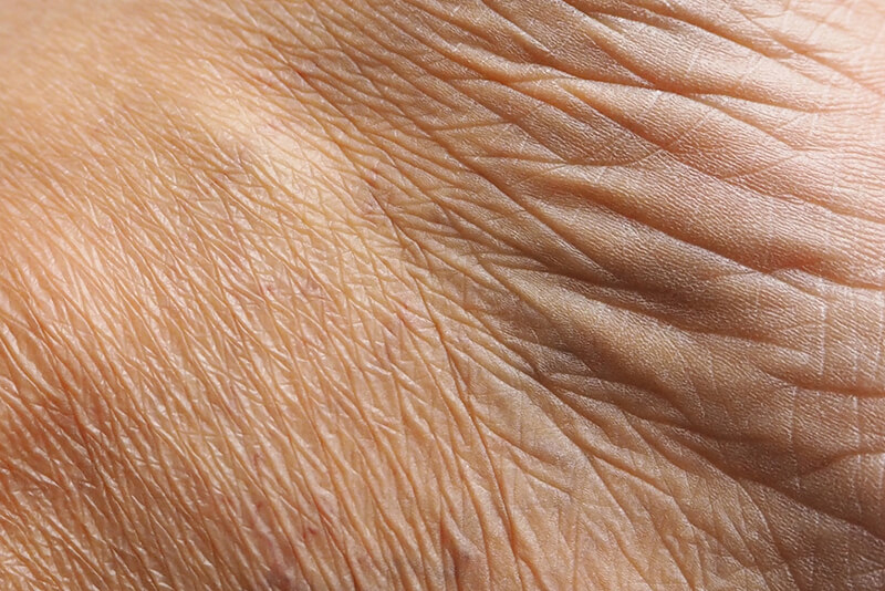 Aging skin